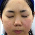 脂漏性皮膚による頬の赤み対策