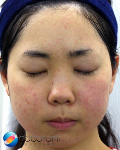 脂漏性皮膚による頬の赤み対策