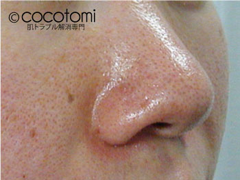 小鼻の赤みの対策 ニキビケアは根本対策のこことみグループ Cocotomi